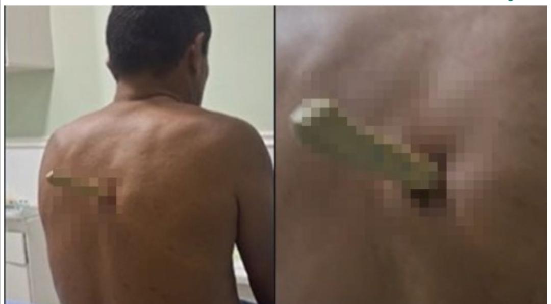 Homem fica com faca cravada nas costas.